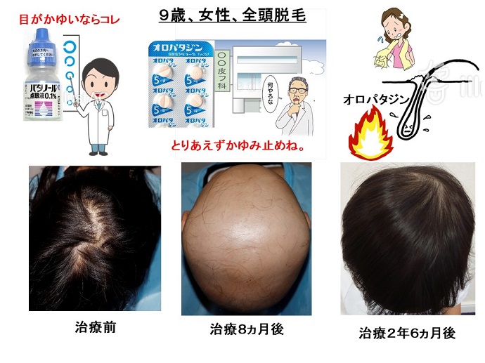 円形脱毛症　病院